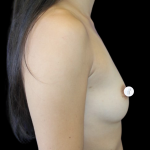 Breast Augmentation (Silicone) Before & After Patient #2464