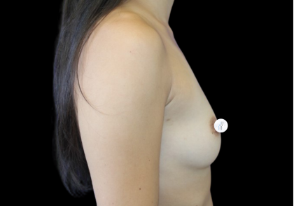 Breast Augmentation (Silicone) Before & After Patient #2464