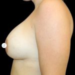 Breast Augmentation (Silicone) Before & After Patient #2882