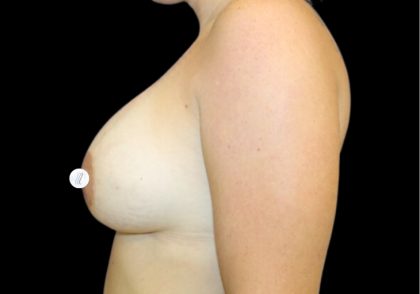 Breast Augmentation (Silicone) Before & After Patient #2882