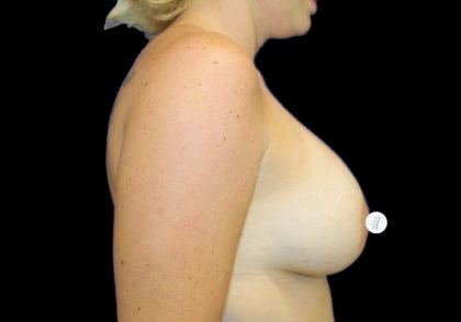 Breast Augmentation (Silicone) Before & After Patient #2882