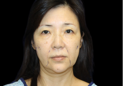 Blepharoplasty Before & After Patient #2451