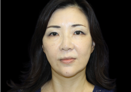 Blepharoplasty Before & After Patient #2451