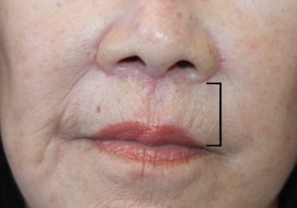 Facelift Before & After Patient #2817