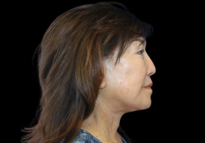 Facelift Before & After Patient #2817