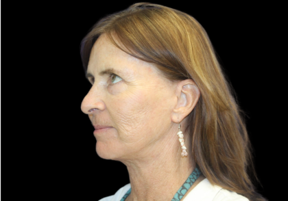 Facelift Before & After Patient #2468