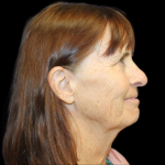 Facelift Before & After Patient #2468
