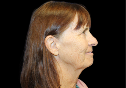 Facelift Before & After Patient #2468