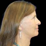 Facelift Before & After Patient #2468