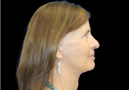 Facelift Before & After Patient #2468