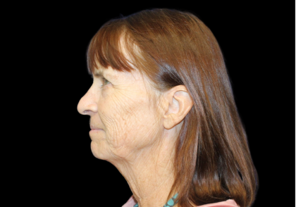 Neck Lift Before & After Patient #2473