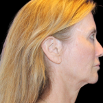 Facelift Before & After Patient #2469