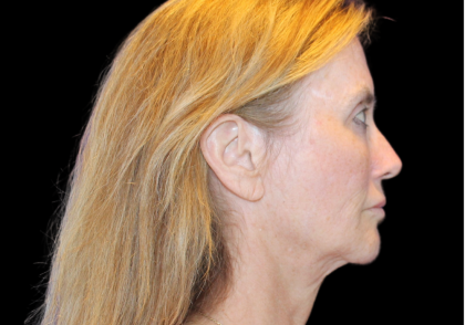 Facelift Before & After Patient #2469