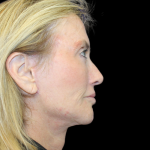 Facelift Before & After Patient #2469