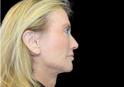 Facelift Before & After Patient #2469