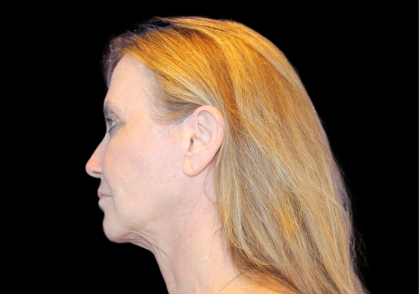 Neck Lift Before & After Patient #2474