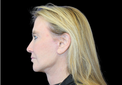 Neck Lift Before & After Patient #2474