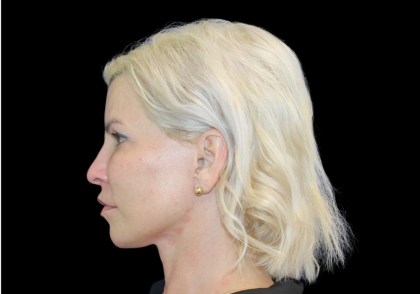 Neck Lift Before & After Patient #2475