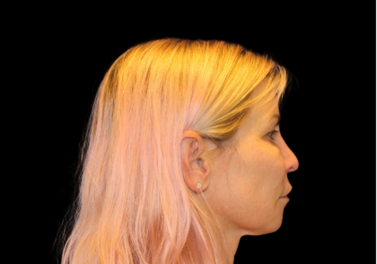 Neck Lift Before & After Patient #2475