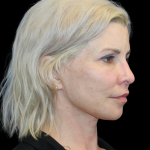 Facelift Before & After Patient #2470