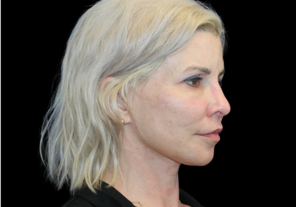 Facelift Before & After Patient #2470