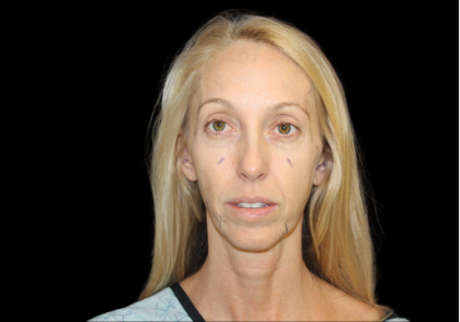 Facelift Before & After Patient #2471
