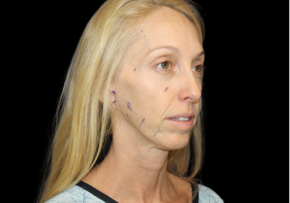 Facelift Before & After Patient #2471