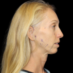 Neck Lift Before & After Patient #2476