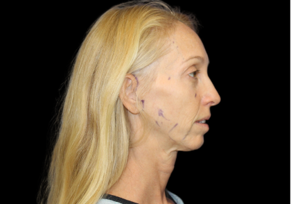 Neck Lift Before & After Patient #2476