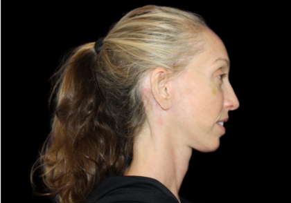 Neck Lift Before & After Patient #2476