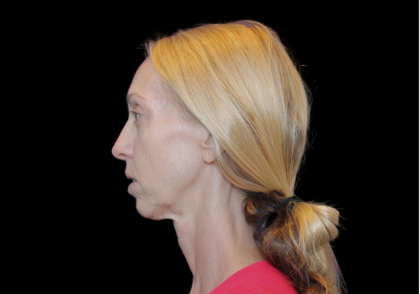 Neck Lift Before & After Patient #2476