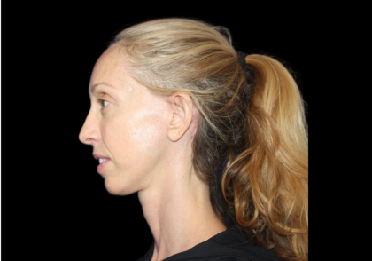 Neck Lift Before & After Patient #2476