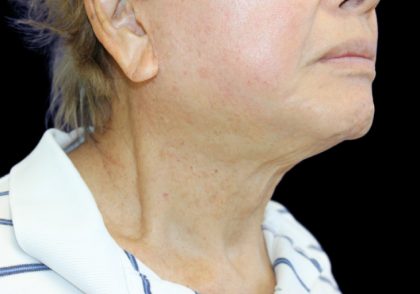 Neck Lift Before & After Patient #2904