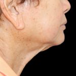 Neck Lift Before & After Patient #2904