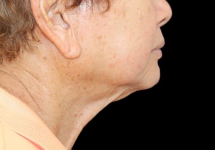 Neck Lift Before & After Patient #2904