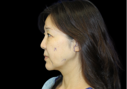 Facelift Before & After Patient #2472