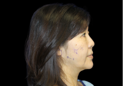 Facelift Before & After Patient #2472