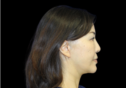 Facelift Before & After Patient #2472