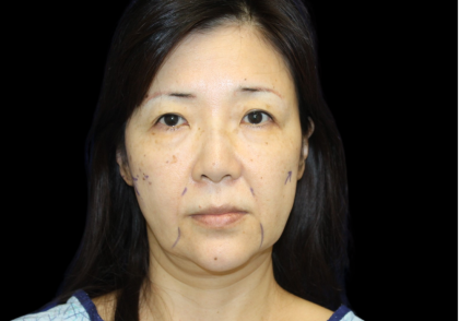 Facelift Before & After Patient #2472