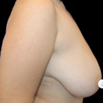Breast Lift Before & After Patient #2465