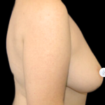 Breast Lift Before & After Patient #2465