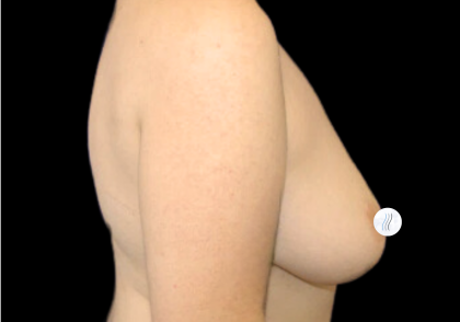 Breast Lift Before & After Patient #2465