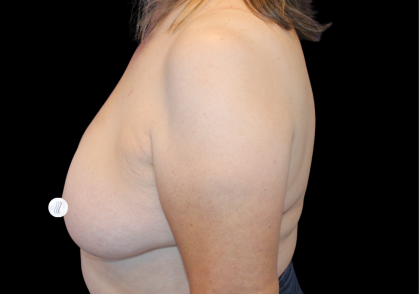 Breast Lift Before & After Patient #2467