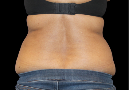 Liposuction Abdomen Before & After Patient #2801