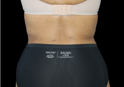 Liposuction Abdomen Before & After Patient #2801