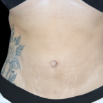 Liposuction Before & After Patient #2803