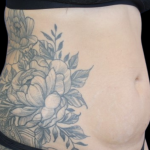Liposuction Before & After Patient #2803