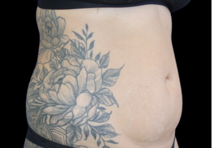 Liposuction Abdomen Before & After Patient #2803