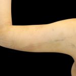 Liposuction to Arms Before & After Patient #2827