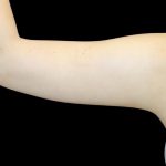 Liposuction to Arms Before & After Patient #2827